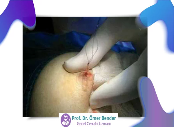 memede papilloma nedir