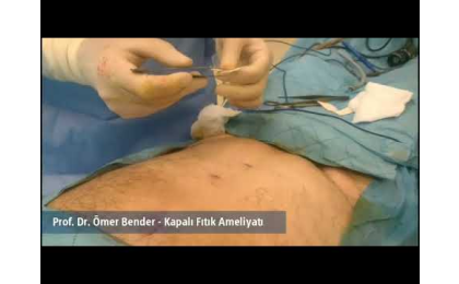 kapalı fıtık ameliyatı