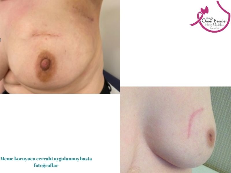 meme-koruyucu-mastektomi-nedir