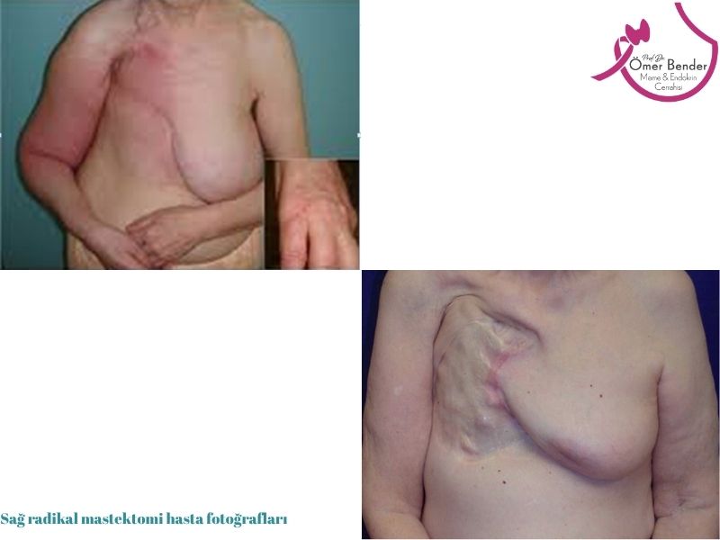radikal-mastektomi-ne