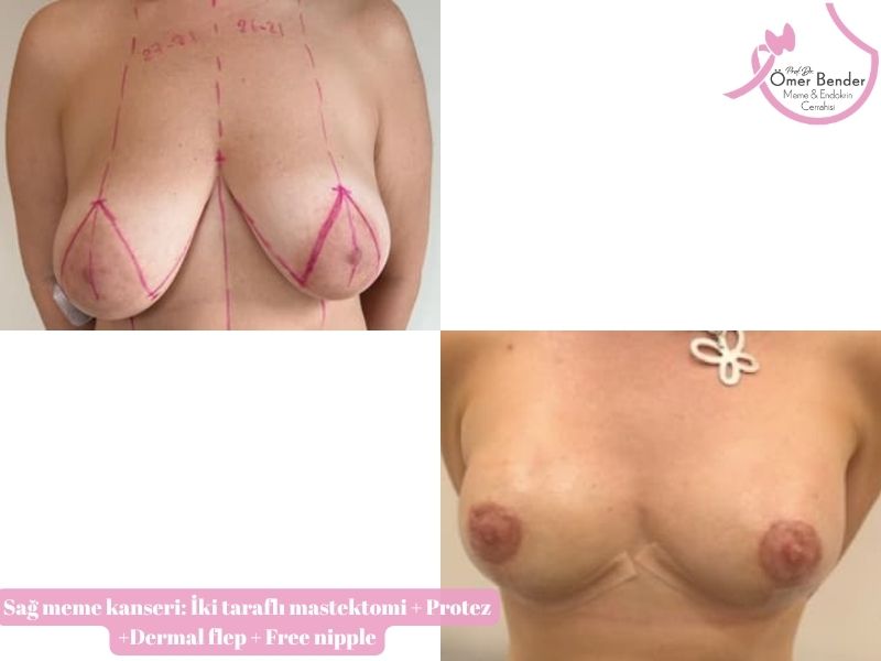 iki-tarafli-mastektomi-protez-dermal-flep-free-nipple