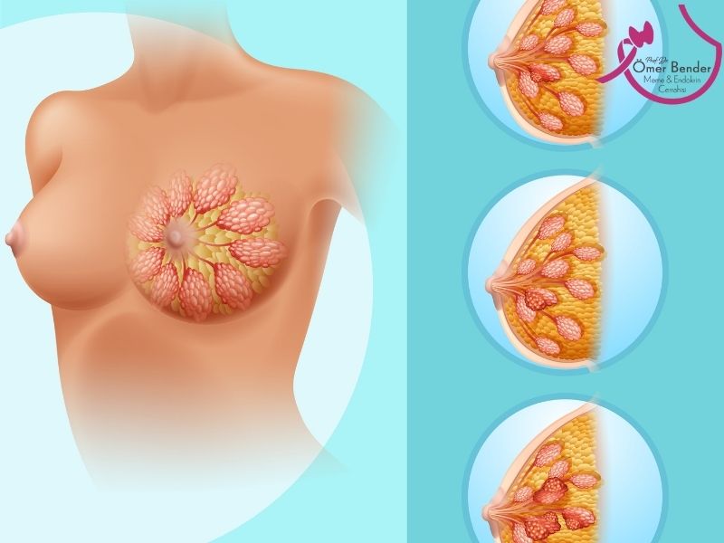 İntraduktal Papillom Özellikleri Nelerdir