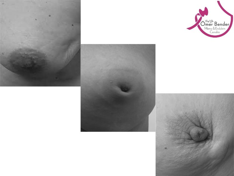 meme-cildinde-odem-sislik-ice-dogru-cekintiler