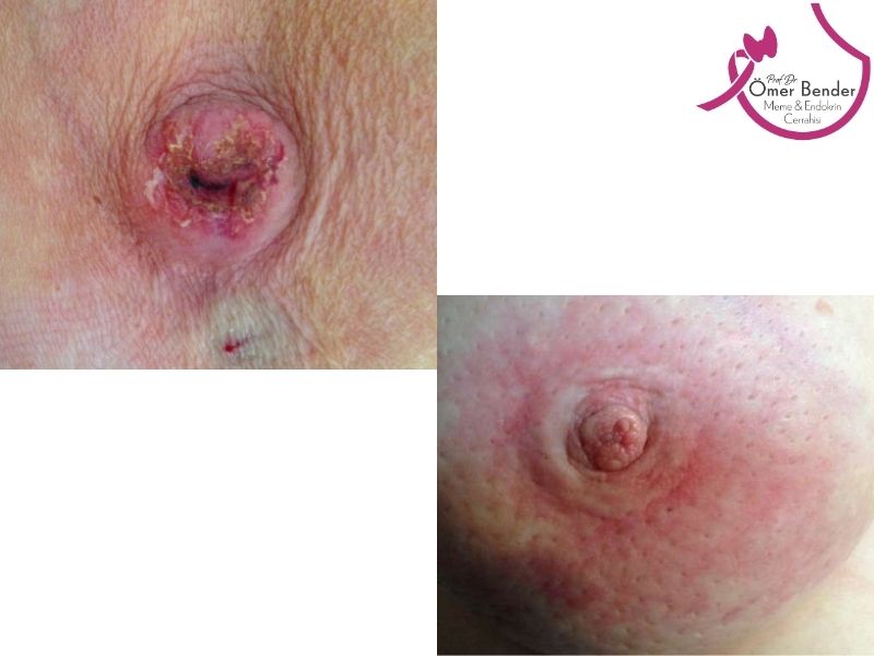 meme-cildinde-yara-veya-kizariklik