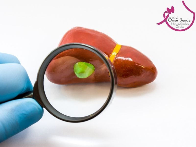 Safra Kesesi İltihabı Kendiliğinden Geçer mi