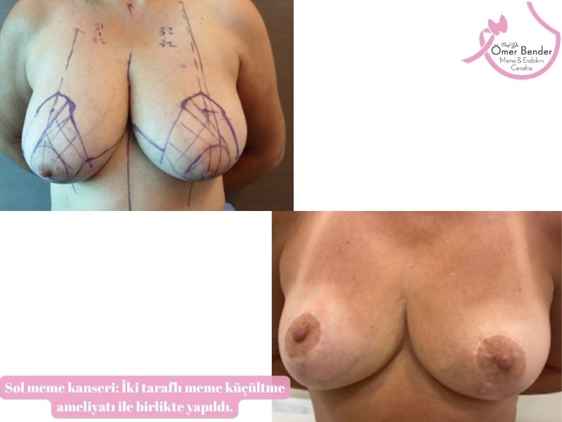 sol-meme-kanseri-iki-tarafli-meme-kucultme-ameliyati-ile-birlikte-yapildi