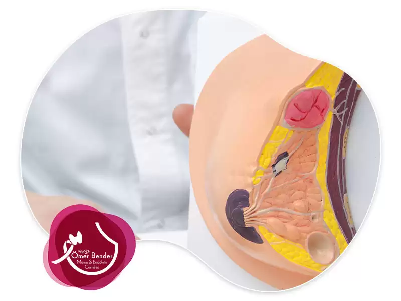 Meme Başı Akıntısı Meme Kanseri Belirtisi midir?