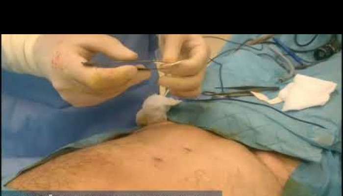 kapalı fıtık,kapalı fıtık ameliyatı,ömer bender