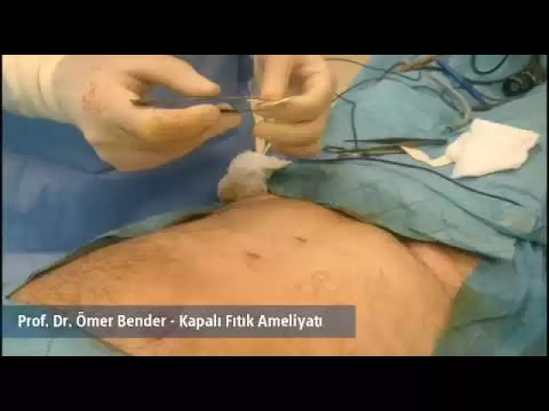 kapalı fıtık,kapalı fıtık ameliyatı,ömer bender